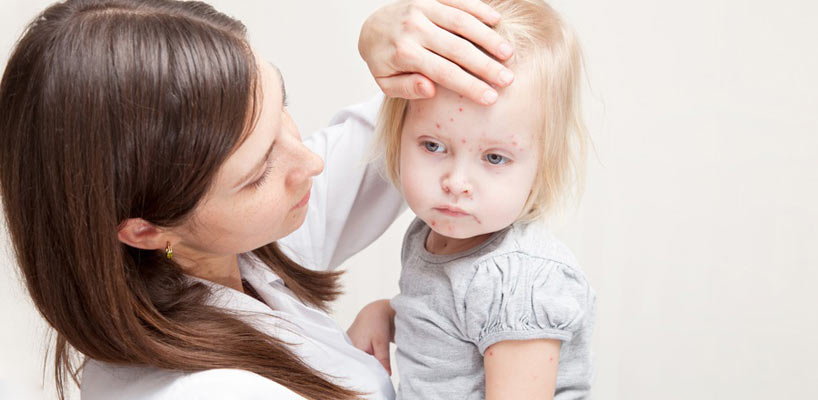 pige med skoldkopper