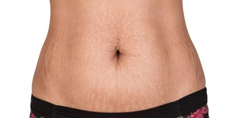 mave med strækmærker